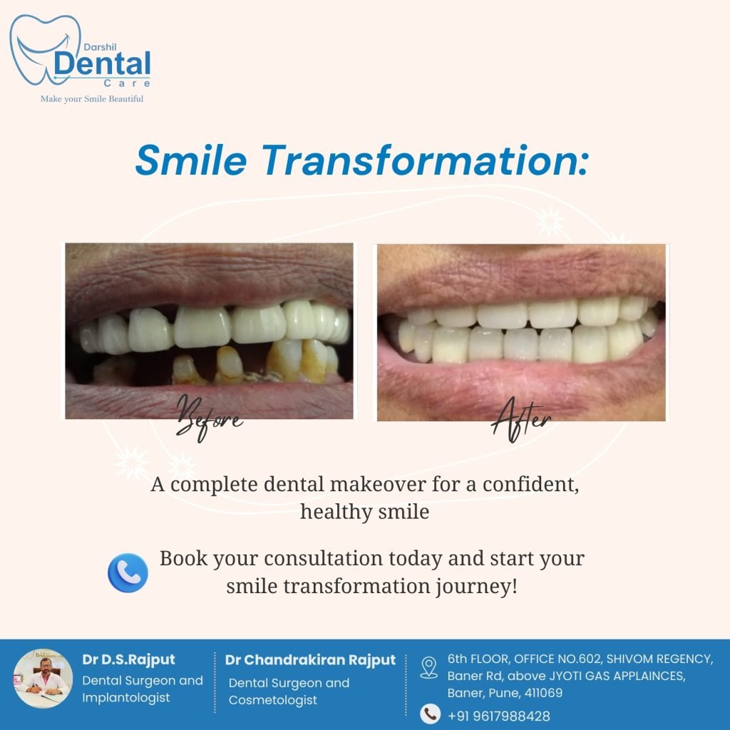 Inplant dental clinic in baner