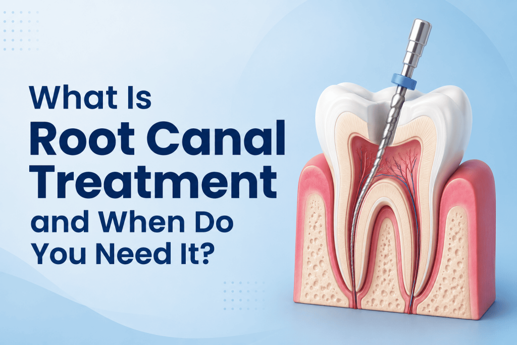 Root Canal Treatment in pan card clun road